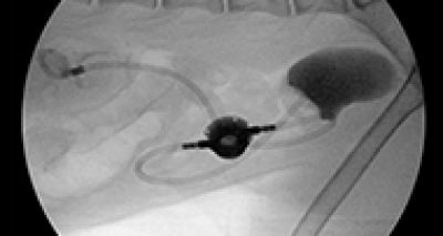 Study highlights risks of subcutaneous ureteral bypass placement